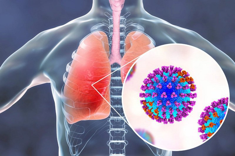 Nấm gây tổn thương ở phổi, gây ra viêm phổi   
